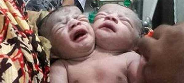 Nació una niña con dos cabezas en Bangladesh